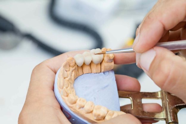 dental bridges dentist creating dental bridges for a patient