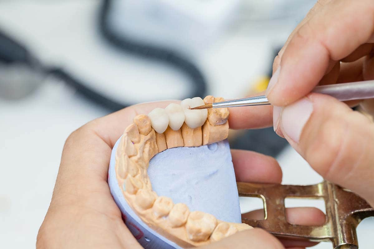 Dental Bridges General Dentistry Services Baytown Tx Dental Services
