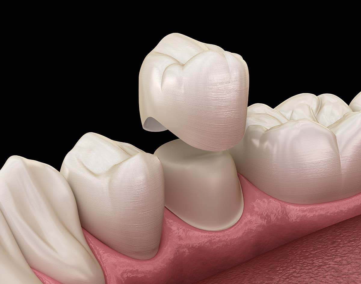 what are dental crowns an example of dental crowns being placed