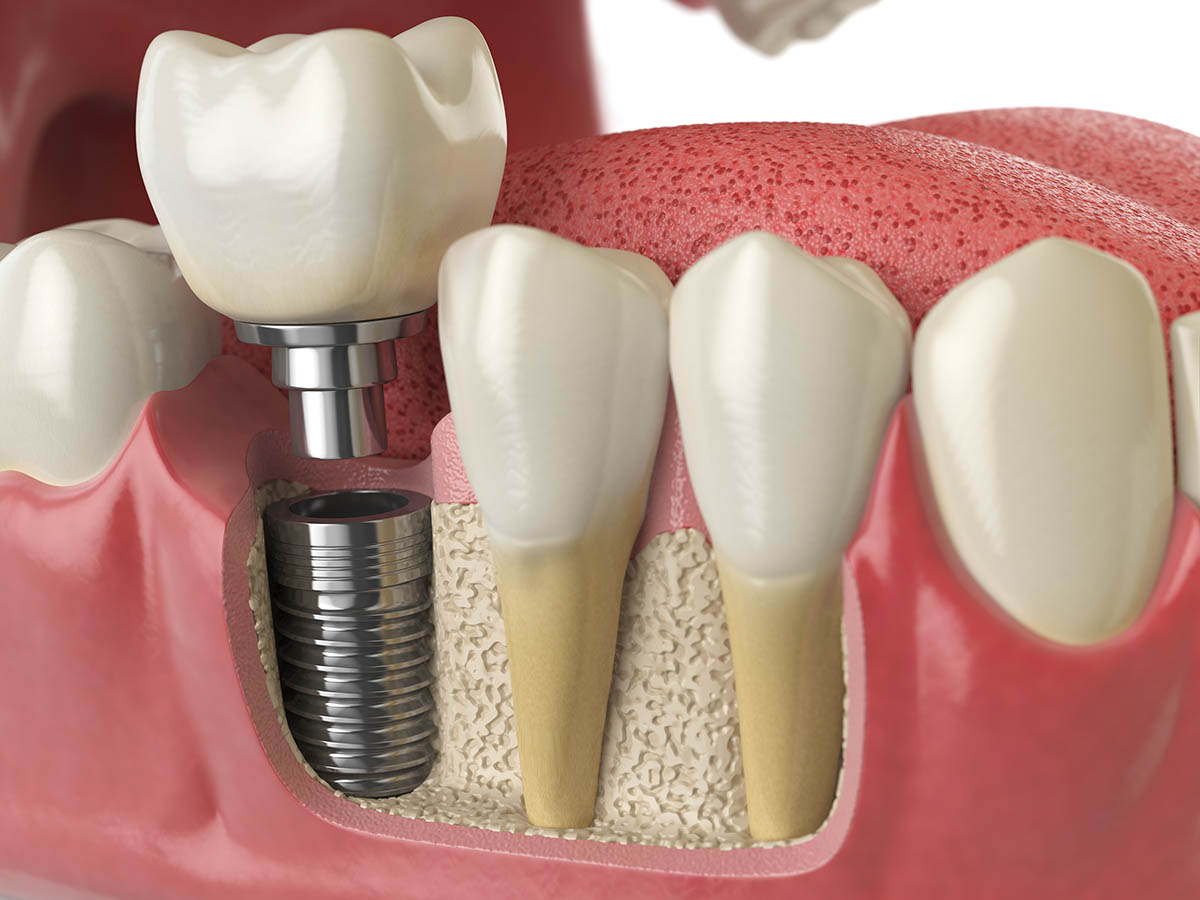 what are dental implants (5) animation showing teeth and jaw what are dental implants