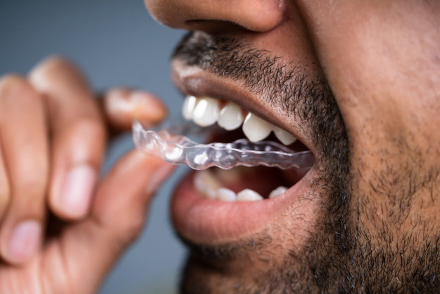how to prevent teeth shifting man inserting retainer to prevent teeth shifting