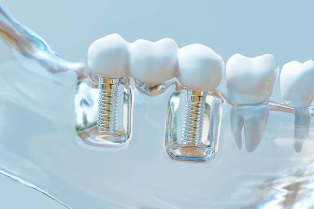 dental-implants (1) showing how dental implants work