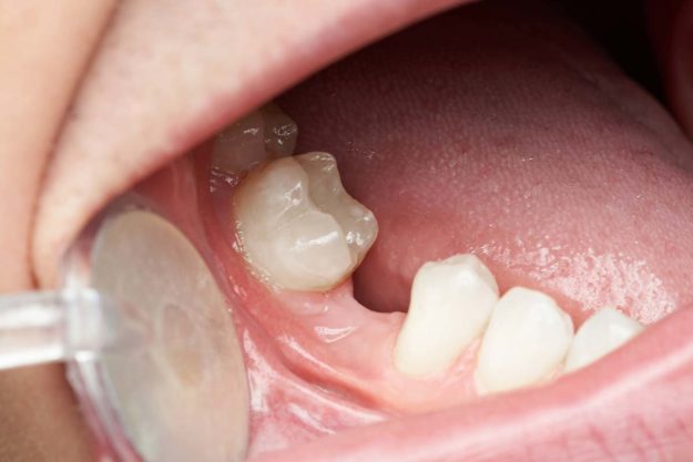teeth-replacements person getting teeth replacements
