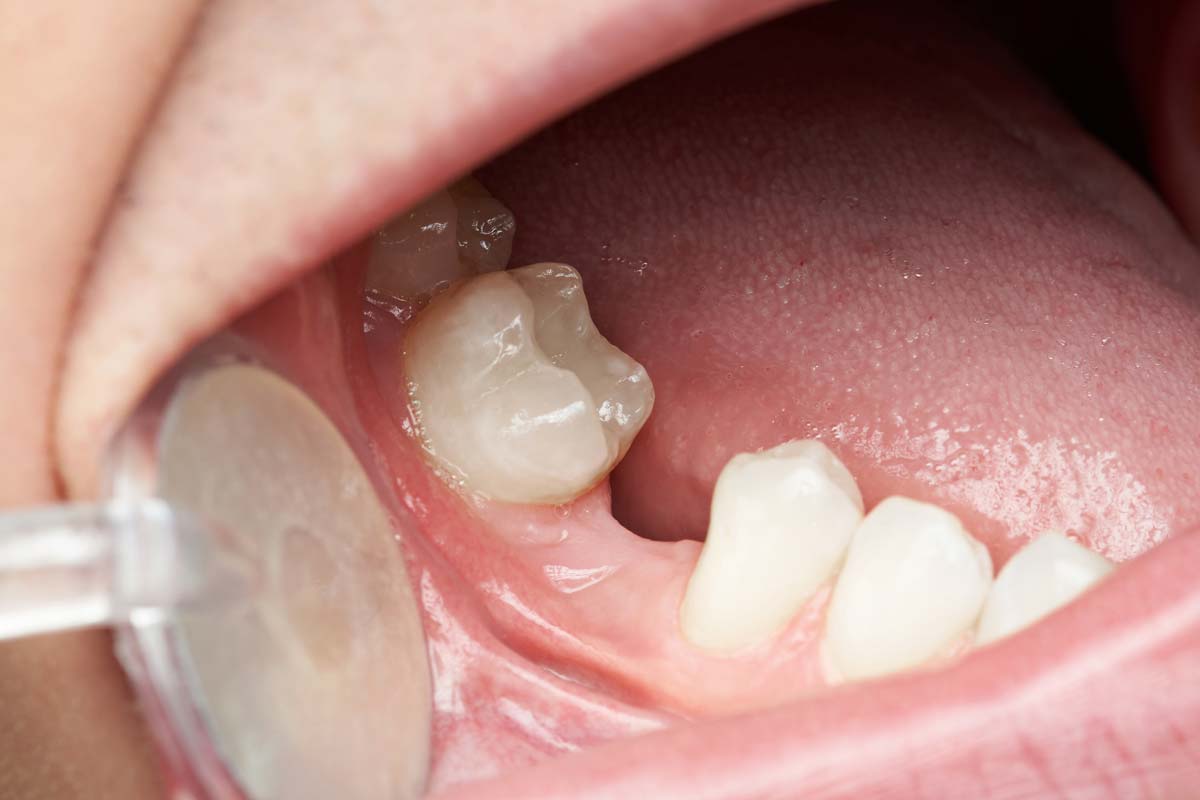 person getting teeth replacements