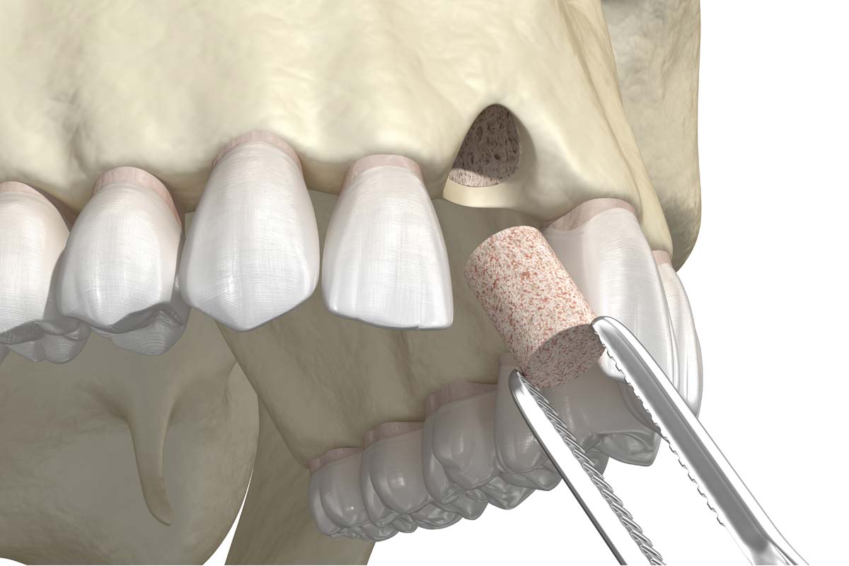 Dental Bone Grafting in TX General Dentistry Services