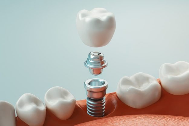 before and after dental implants graphic showing before and after dental implants