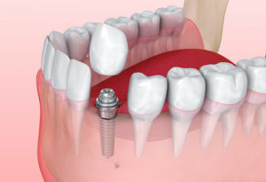 dental crowns and bridges for teeth