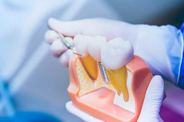 What-is-a-Single-Tooth-Implant- example of a single tooth implant