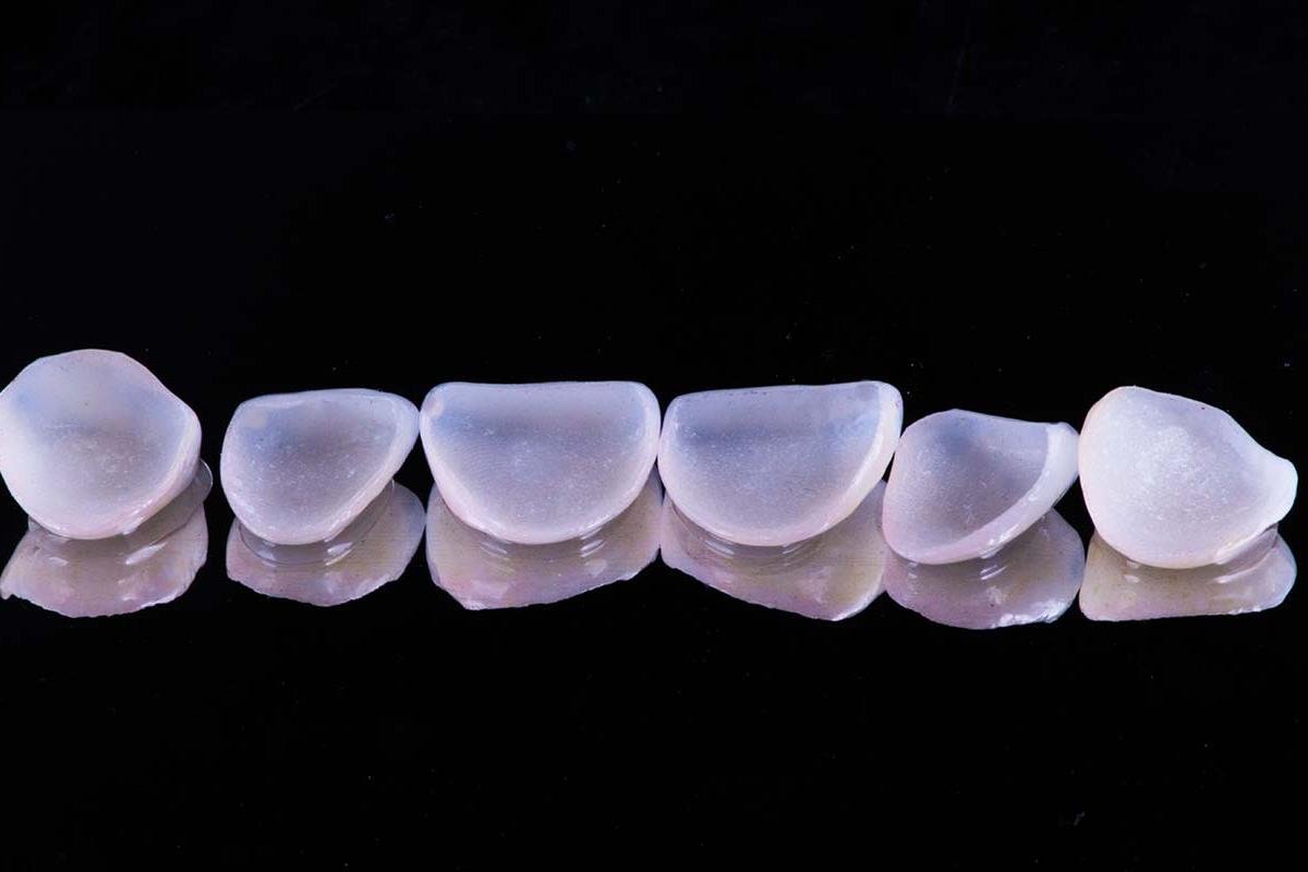 benefits of dental veneers